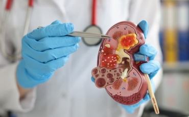 Como saber se estou com pedras nos rins?