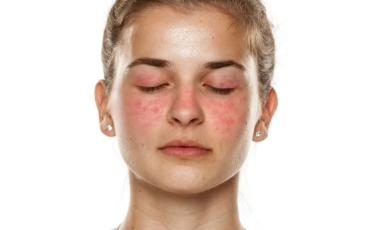 Lúpus: quando o sistema imunológico ataca o próprio corpo