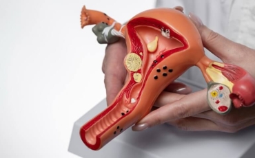 Síndrome dos Ovários Policísticos: entenda como afeta a saúde reprodutiva