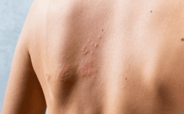 Herpes Zóster: causas, sintomas e tratamento